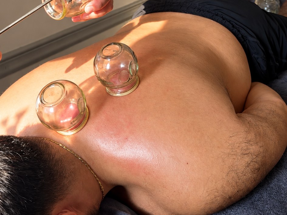Cupping Thérapie